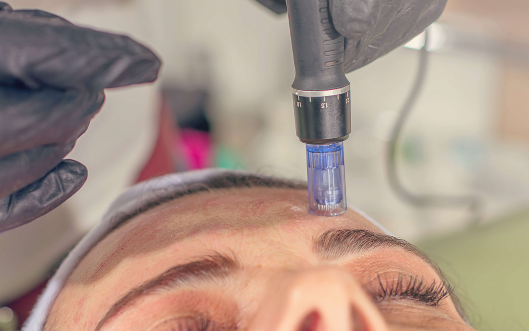 (Microneedling)-Collagen induction therapy